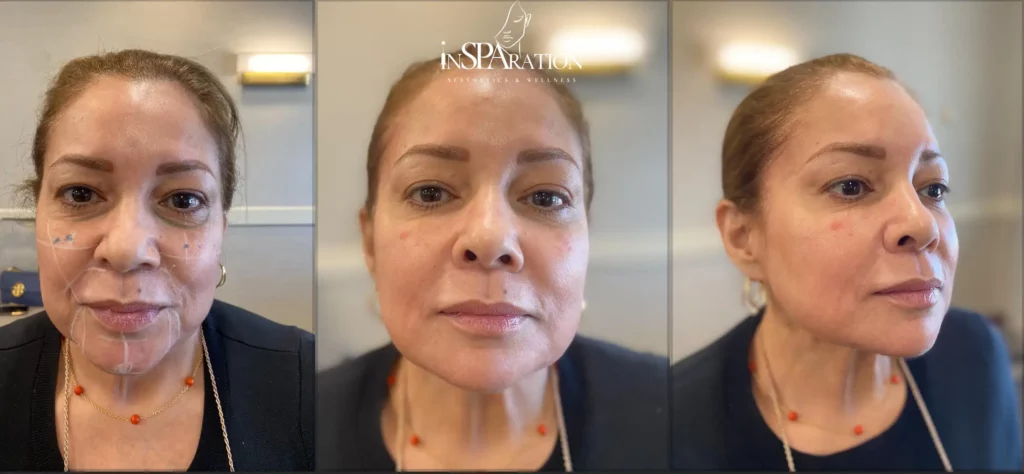 inSPAration Aesthetics before & after