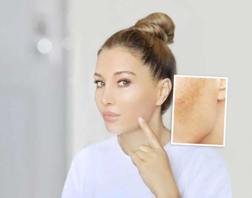 Hyperpigmentation by inSPAration Aesthetics & Wellness in Old Bridge, NJ