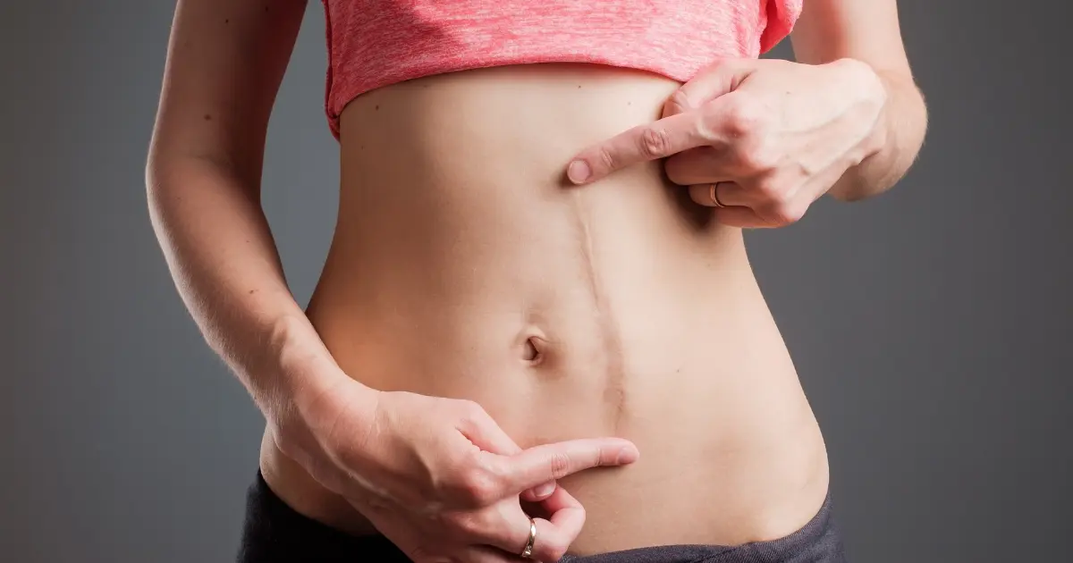 A person points to a scar on their abdomen, illustrating scar revision in Old Bridge, NJ
