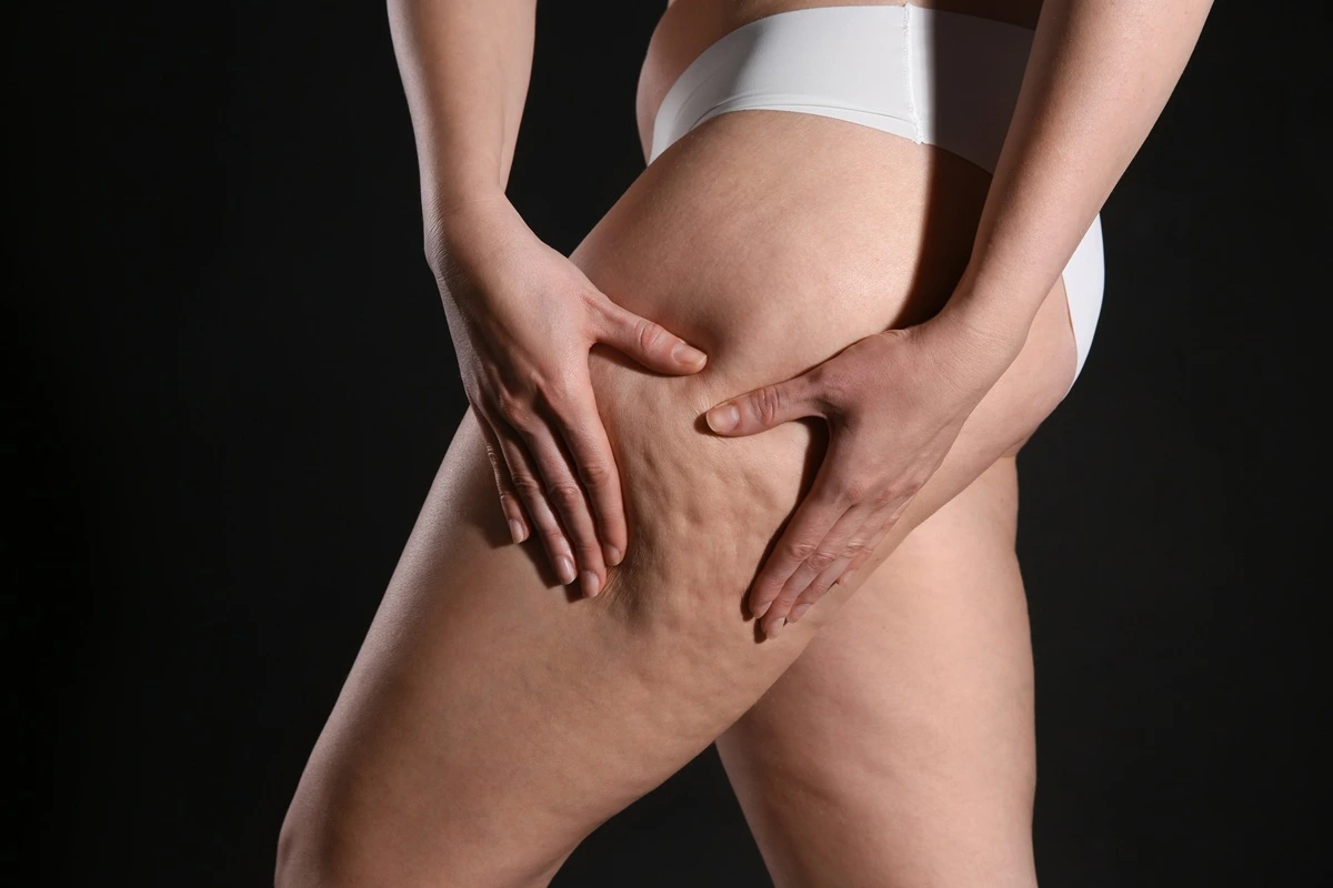 Cellulite on thighs before treatment at inSPAration Aesthetics & Wellness in Old Bridge NJ